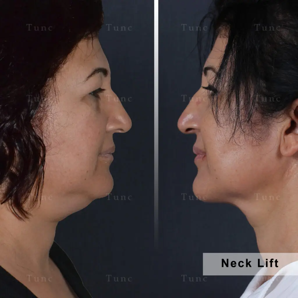 neck lift